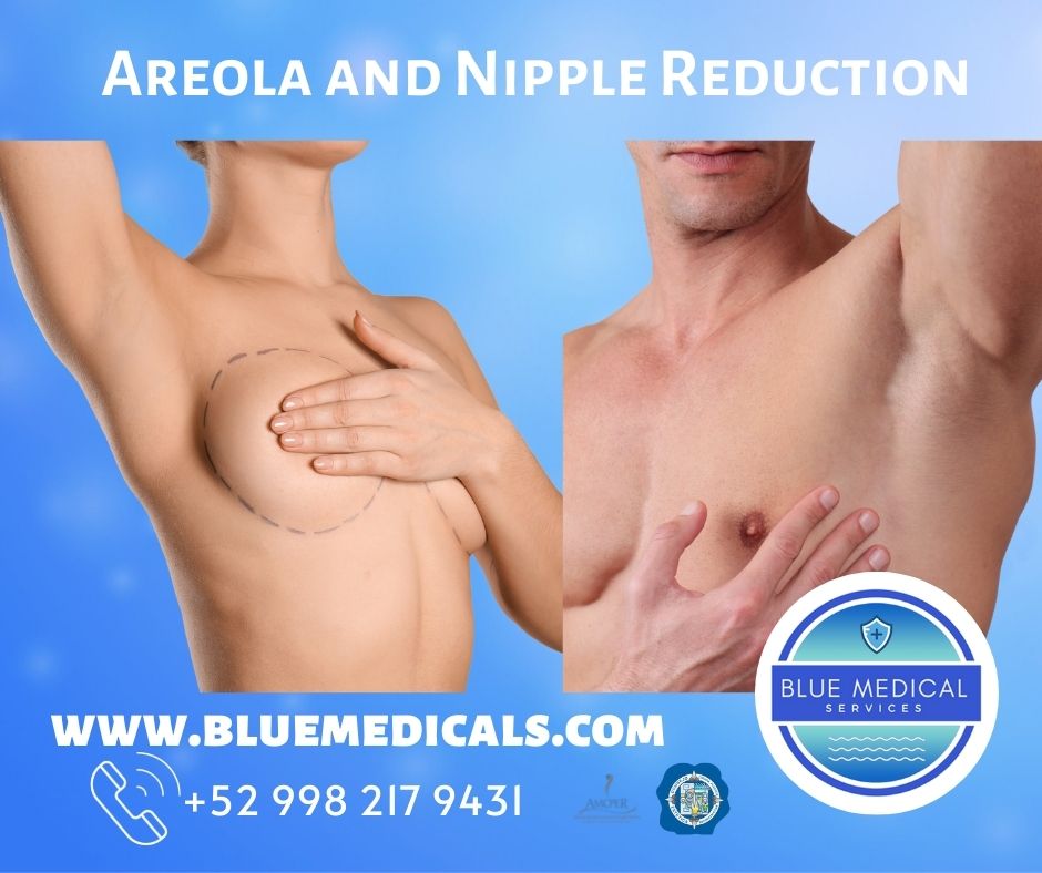 areola reduction in cancun