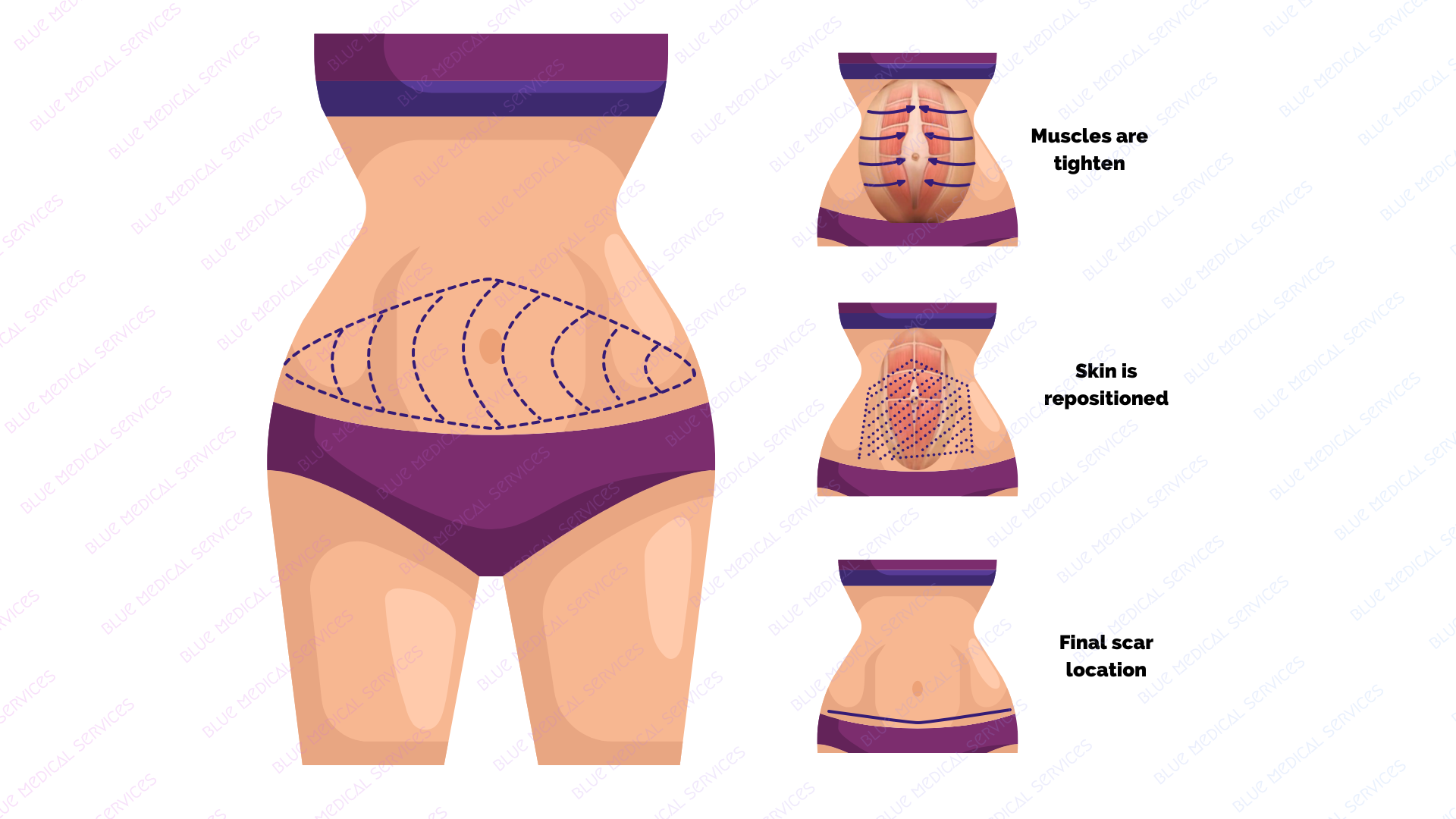tummy tuck with muscle repair in cancun