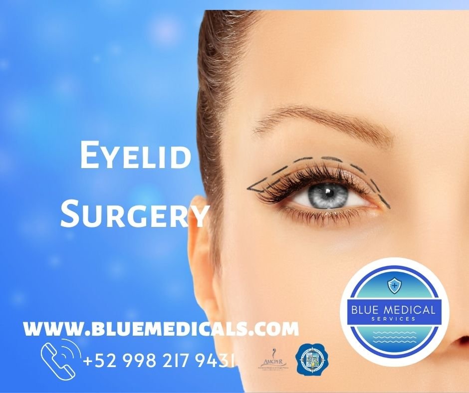 Eyelid Surgery in Cancun