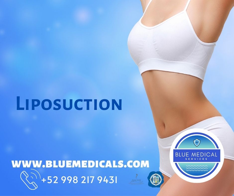 liposuction in cancun blue medical2